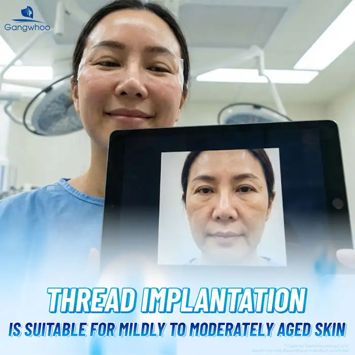 Is Facial Thread Lifting Effective? Does It Provide Long-Term Results?