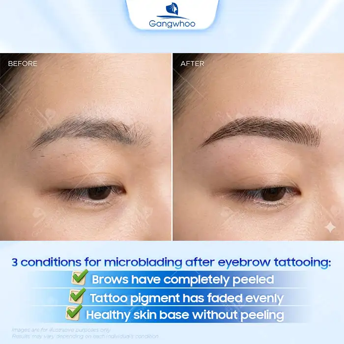 Can Tattooed Eyebrows Be Microbladed? Detailed Explanation from the Doctor