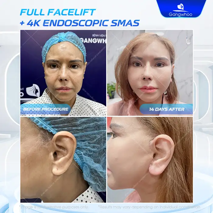 Should You Get a Thread Lift? Important Considerations Before the Procedure