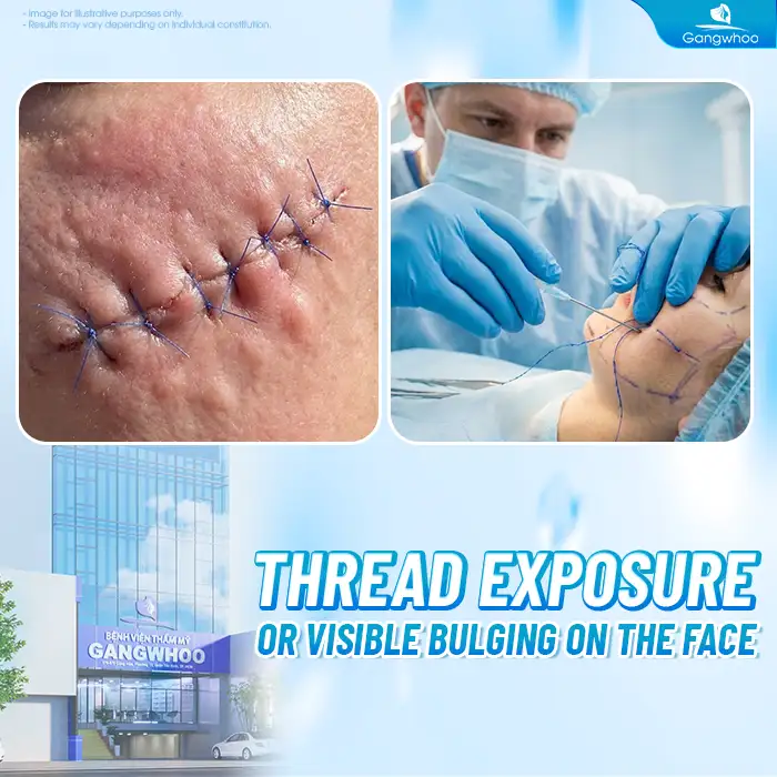 Should You Get a Thread Lift? Important Considerations Before the Procedure