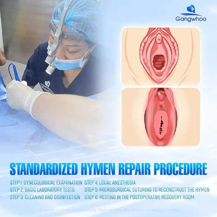 Should You Undergo Hymen Reconstruction? Benefits of Hymen Reconstruction