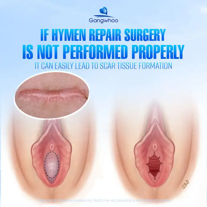 Should You Undergo Hymen Reconstruction? Benefits of Hymen Reconstruction
