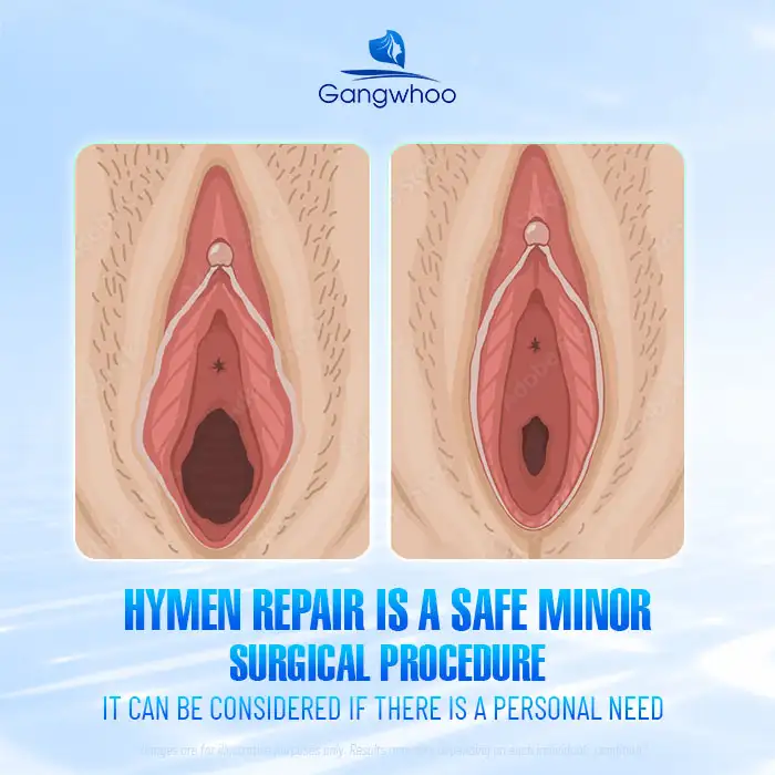 Should You Undergo Hymen Reconstruction? Benefits of Hymen Reconstruction