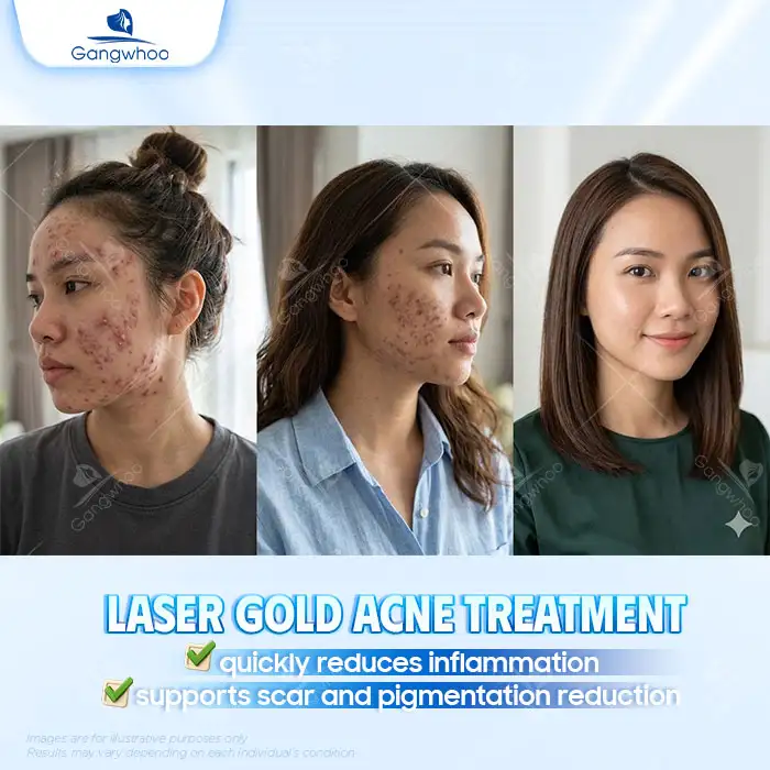 What Is Advanced Acne Treatment? How Many Steps Are Included in the Procedure?