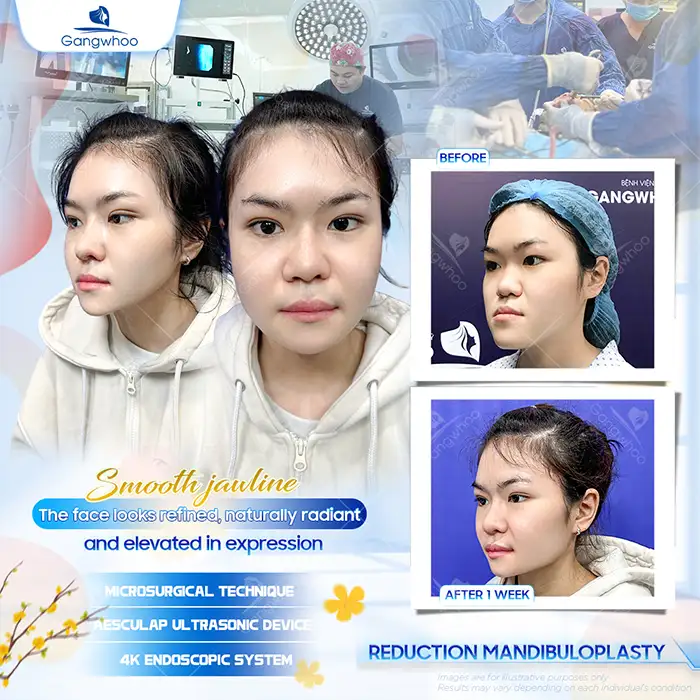 What Is Protruding Jaw Bone Reduction? Advantages, Disadvantages, and the Procedure