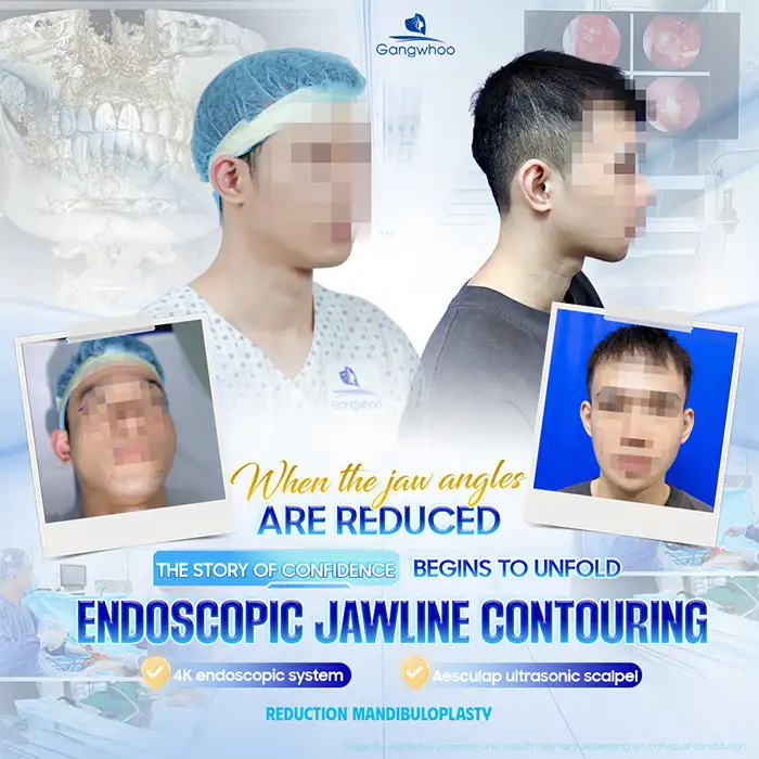 What Is Protruding Jaw Bone Reduction? Advantages, Disadvantages, and the Procedure