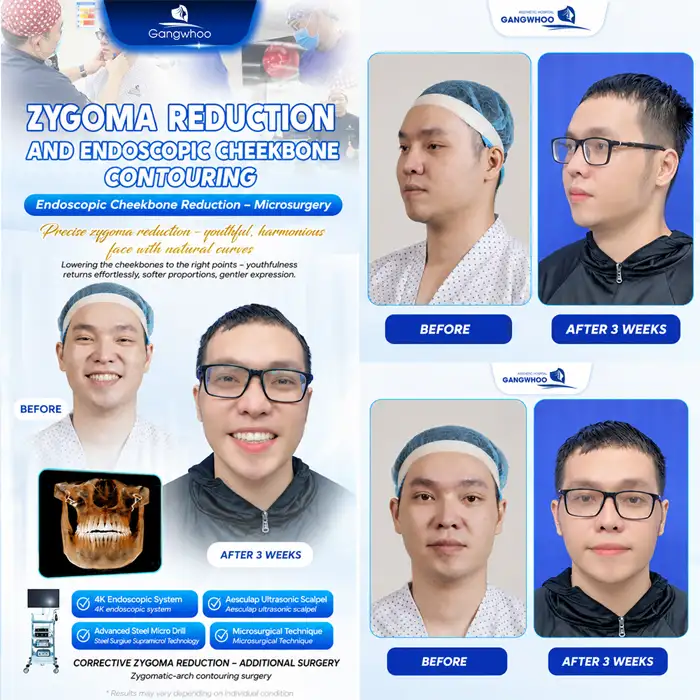 Where Is a Reputable Place for Cheekbone Reduction Installment Plans? What Are the Conditions and Interest Rates?