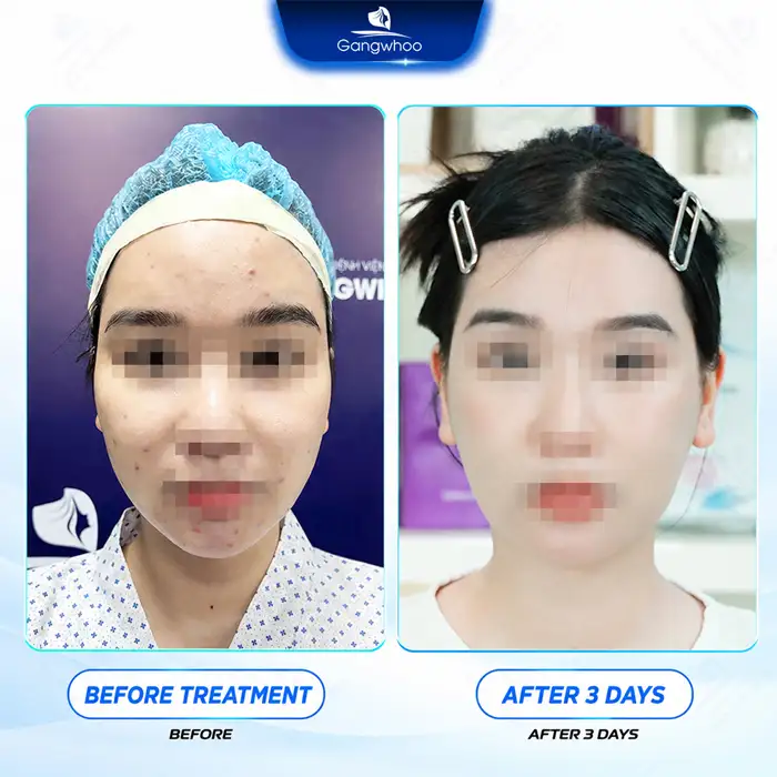 Where Is a Reputable Place for Cheekbone Reduction Installment Plans? What Are the Conditions and Interest Rates?