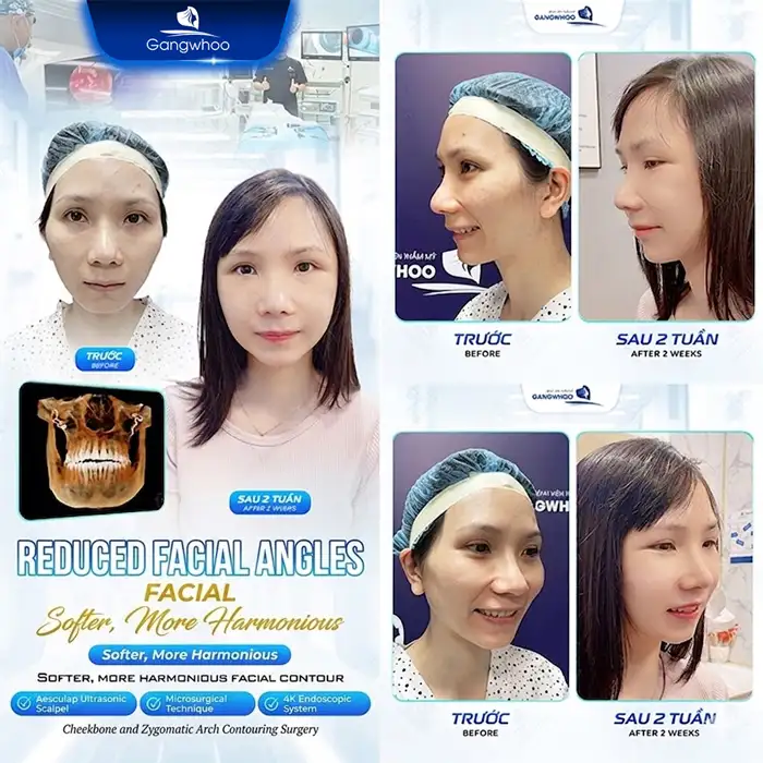 Where Is a Reputable Place for Cheekbone Reduction Installment Plans? What Are the Conditions and Interest Rates?