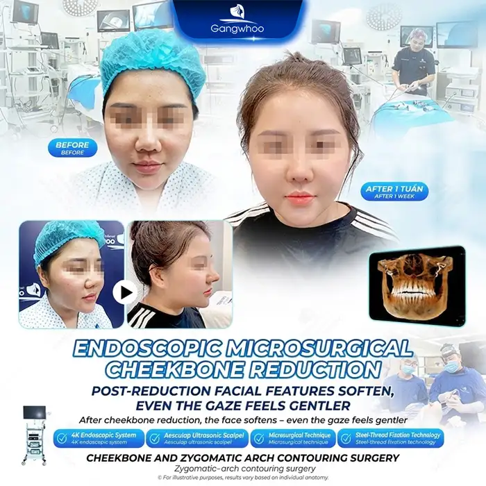 Where Is a Reputable Place for Cheekbone Reduction Installment Plans? What Are the Conditions and Interest Rates?