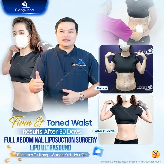 What Is Non-Surgical Abdominal Fat Removal? Does It Deliver High Effectiveness?