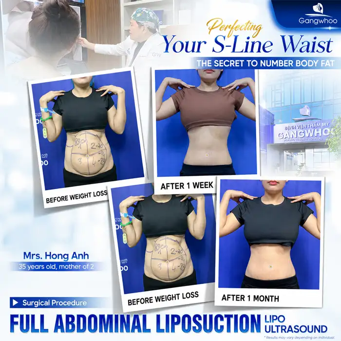 What Is Non-Surgical Abdominal Fat Removal? Does It Deliver High Effectiveness?