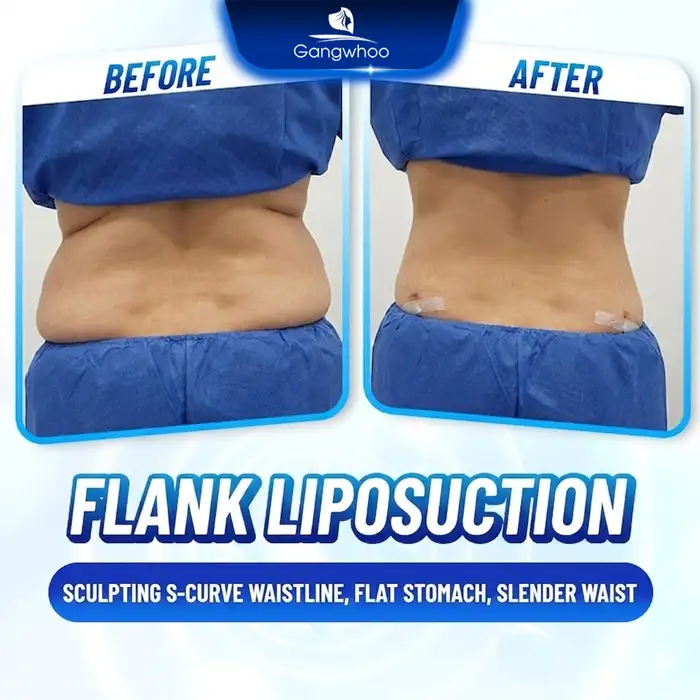 What Is Flank Liposuction? Should You Choose Liposuction for the Flank Area?