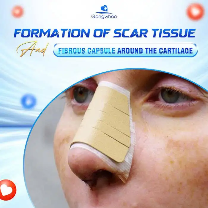 Nasal Tip Hardness After Rhinoplasty: Causes and Treatment Options