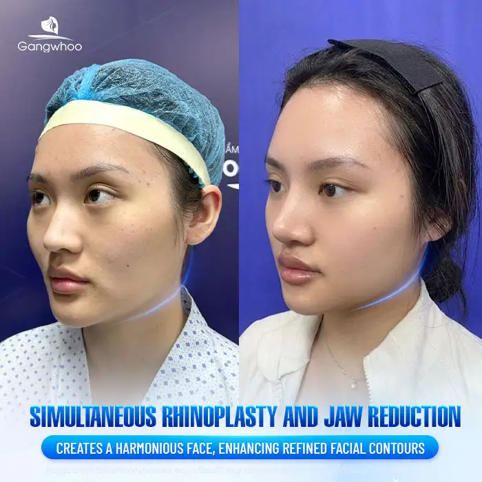 Can Rhinoplasty and Jaw Reduction Surgery Be Performed at the Same Time? Does It Affect Health?