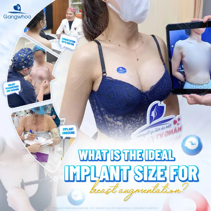 What is considered a beautiful breast augmentation? Factors affecting the beauty of the bust 1 Lưu nháp tự động