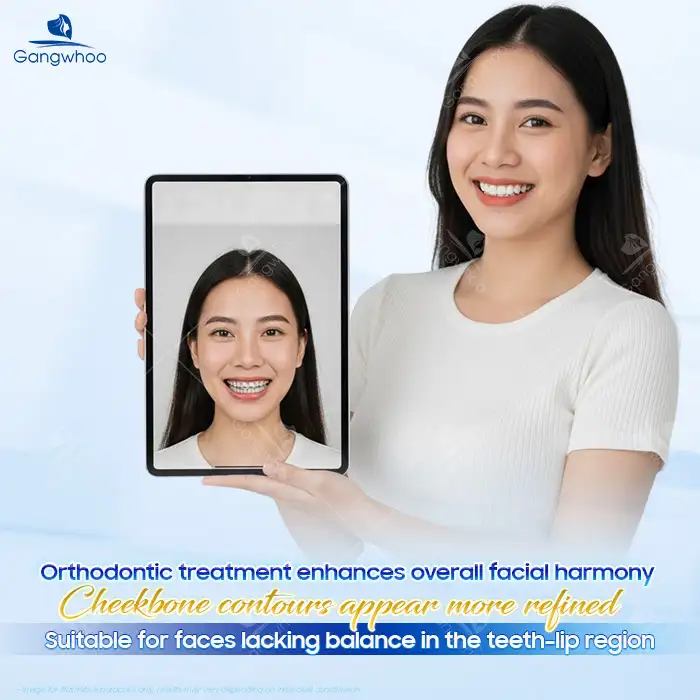 Does Orthodontic Treatment Reduce Cheekbones? Does It Affect or Change the Cheekbones?