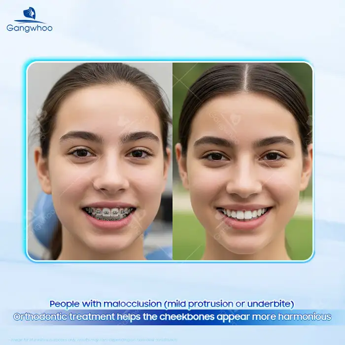 Does Orthodontic Treatment Reduce Cheekbones? Does It Affect or Change the Cheekbones?