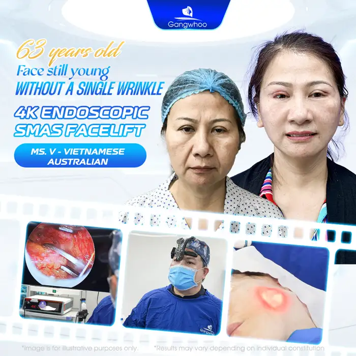 Which Face Lift Method Is the Best? Explore the Most Effective Techniques