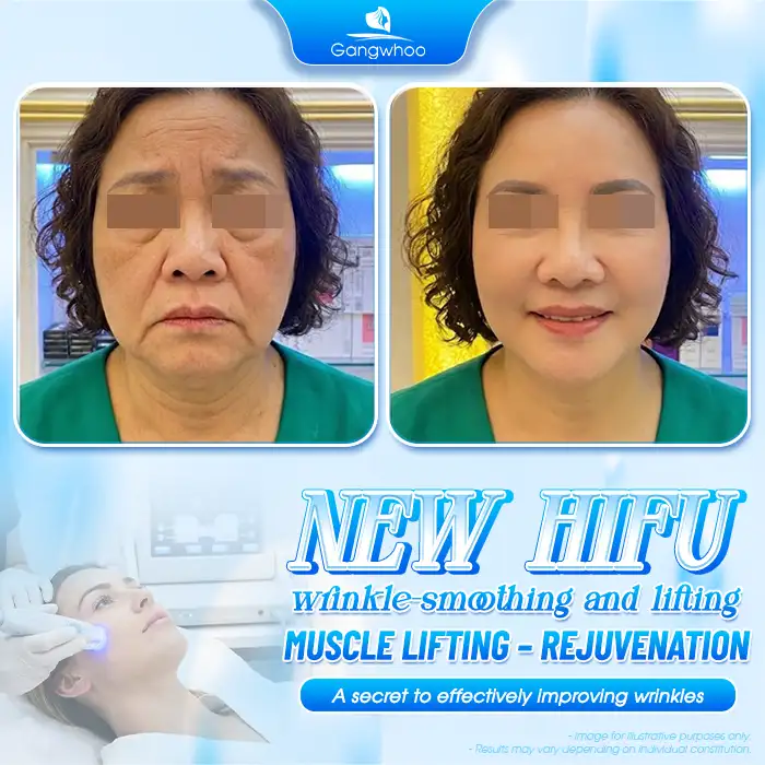 Which Face Lift Method Is the Best? Explore the Most Effective Techniques