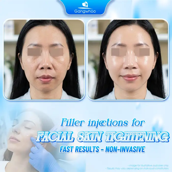 Which Face Lift Method Is the Best? Explore the Most Effective Techniques