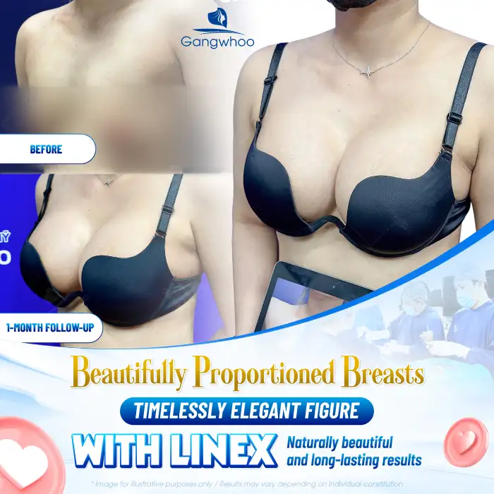 Learn About the Most Popular Breast Implants Today? Which Breast Implant Should You Choose?