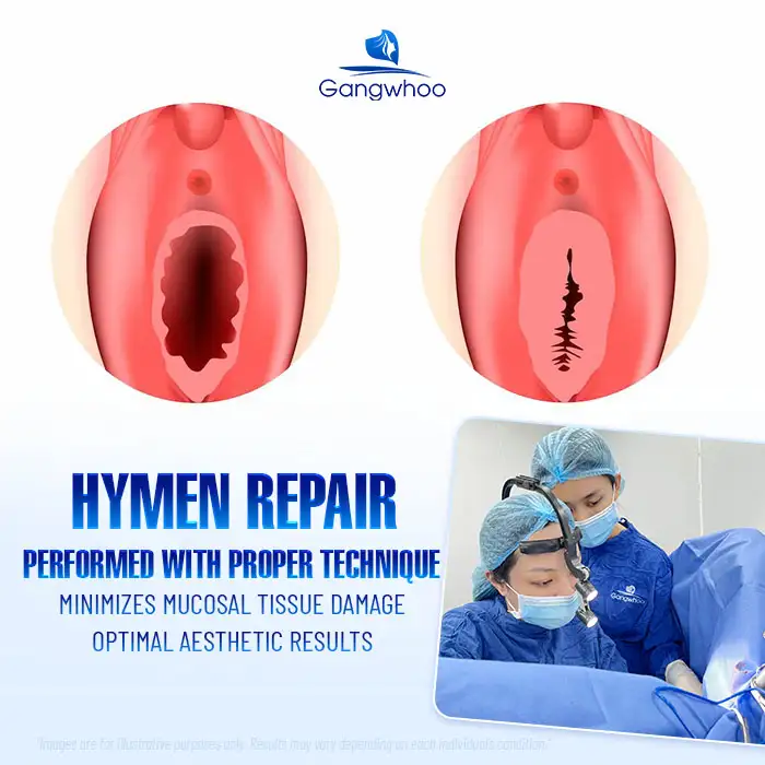 Does Hymen Repair Hurt? Sensations During and After Hymen Repair
