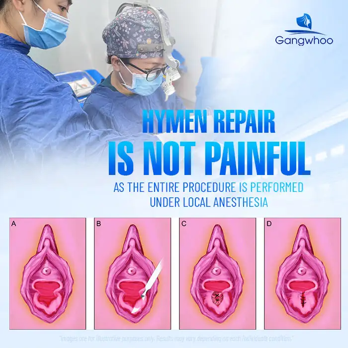 Does Hymen Repair Hurt? Sensations During and After Hymen Repair