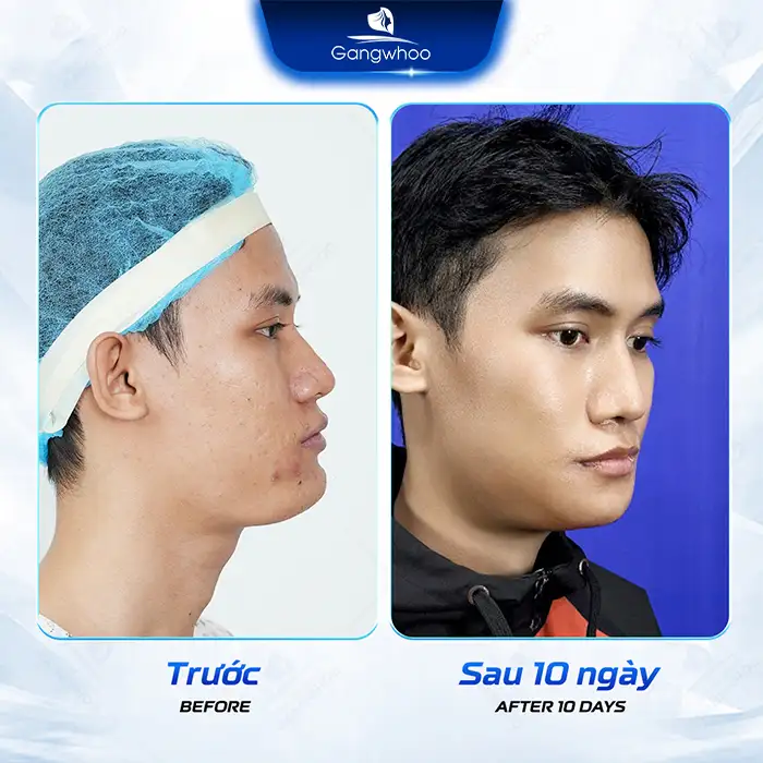 What Is Protruding Jaw Bone Reduction? Advantages, Disadvantages, and the Procedure