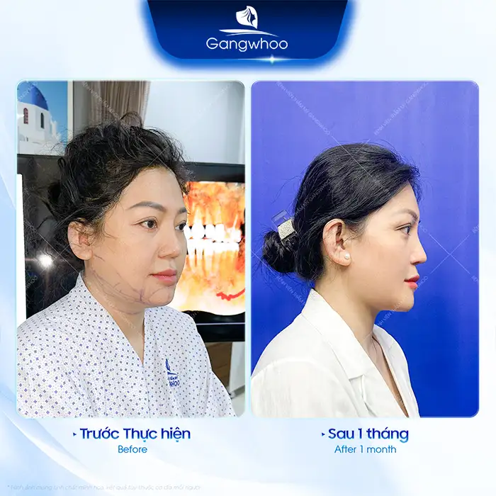 Where Is the Best and Safest Place for Cheekbone Reduction Surgery? Explore 5+ Reputable Clinics
