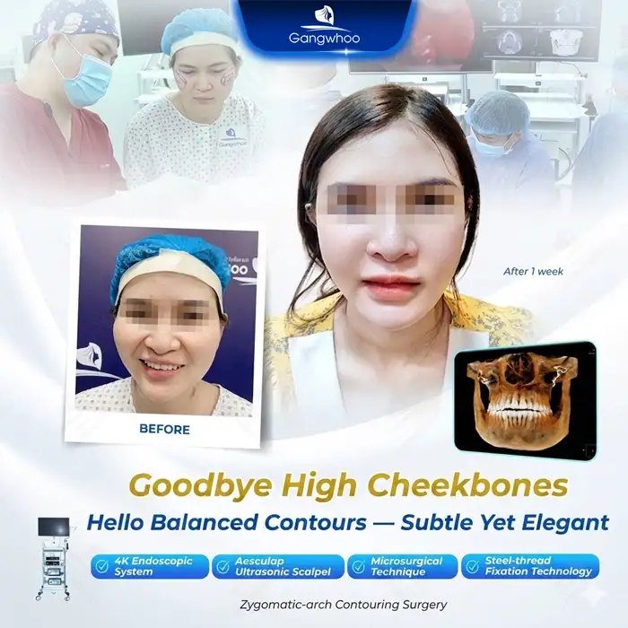 Where Is the Best and Safest Place for Cheekbone Reduction Surgery? Explore 5+ Reputable Clinics
