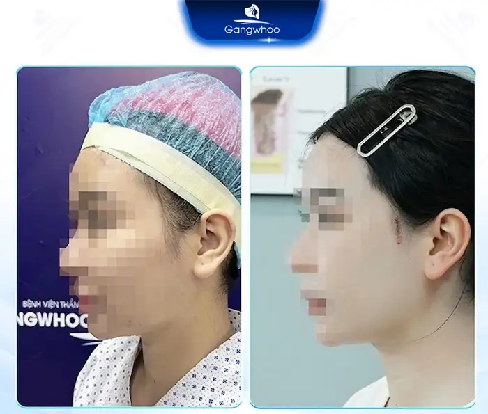 Where Is the Best and Safest Place for Cheekbone Reduction Surgery? Explore 5+ Reputable Clinics