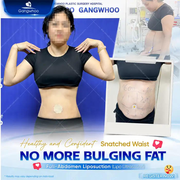Will Liposuction Cause Weight Gain Again? Causes and Prevention Methods