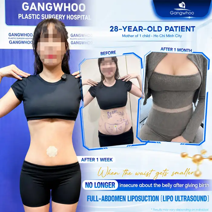 Will Liposuction Cause Weight Gain Again? Causes and Prevention Methods