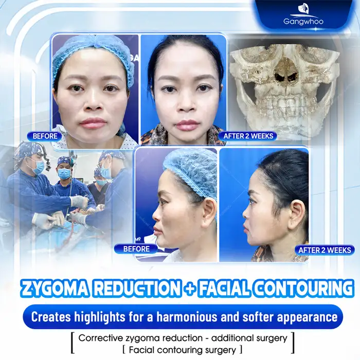 Should You Reduce Cheekbones or Augment the Temples? Which Method Is More Optimal?