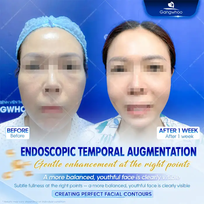 Should You Reduce Cheekbones or Augment the Temples? Which Method Is More Optimal?