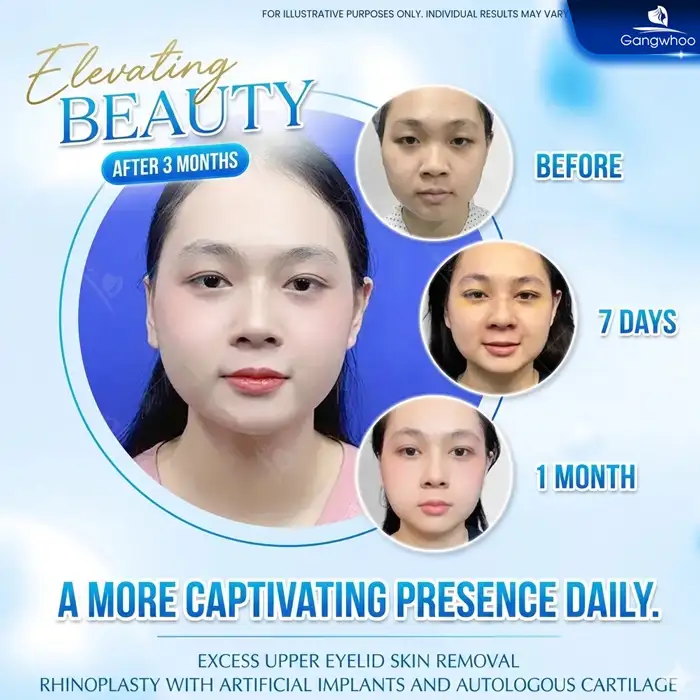 Eyelid Surgery: Is It Dangerous? Key Factors to Consider