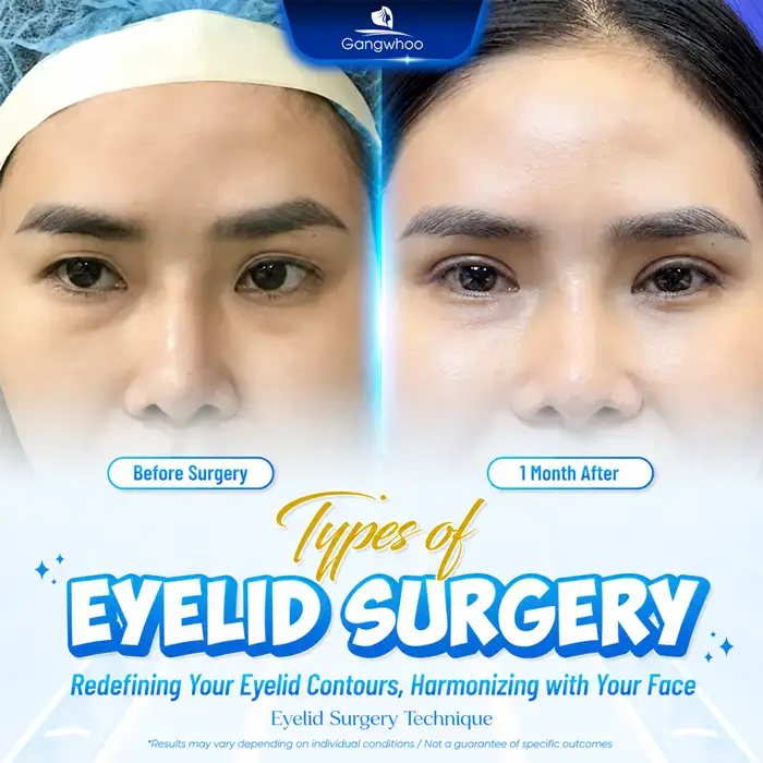 Eyelid Surgery: Is It Dangerous? Key Factors to Consider