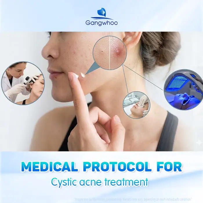 Causes of Cystic Acne and How to Treat It Without Leaving Unsightly Scars