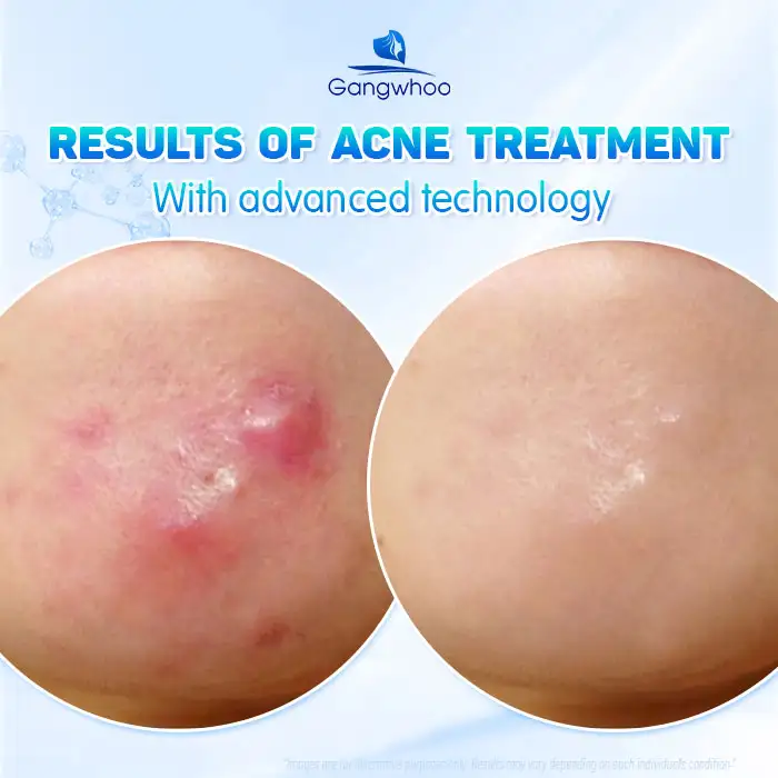 Causes of Cystic Acne and How to Treat It Without Leaving Unsightly Scars