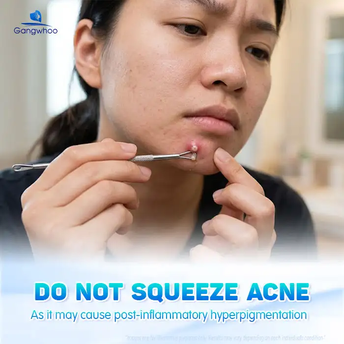 Causes of Cystic Acne and How to Treat It Without Leaving Unsightly Scars