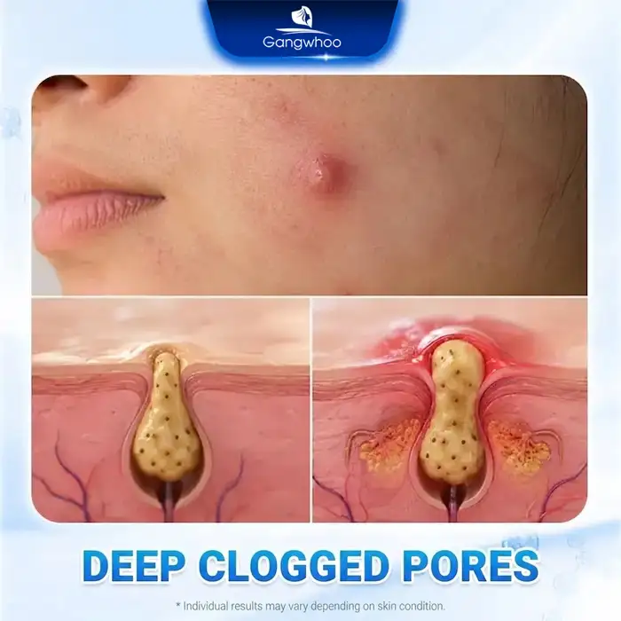 Causes of Cystic Acne and How to Treat It Without Leaving Unsightly Scars