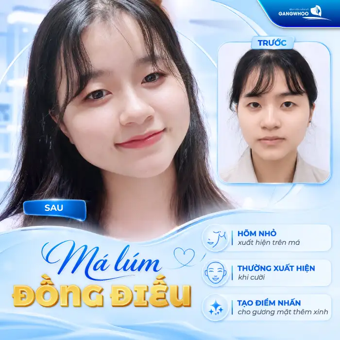 Má Lúm Đồng Điếu Là Gì? Có Ý Nghĩa Gì Và Có Thể Tạo Được Không?