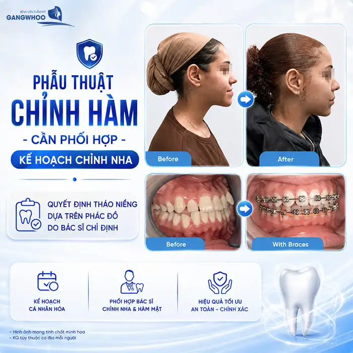 Đang Niềng Răng Có Gọt Hàm Được Không? Bác Sĩ Chia Sẻ