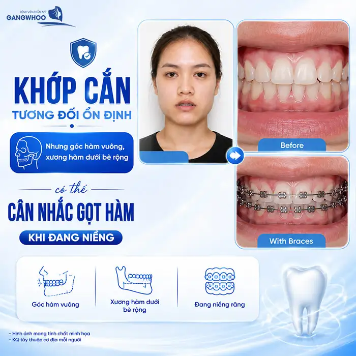 Đang Niềng Răng Có Gọt Hàm Được Không? Bác Sĩ Chia Sẻ