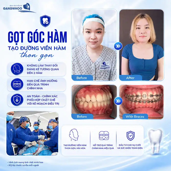 Đang Niềng Răng Có Gọt Hàm Được Không? Bác Sĩ Chia Sẻ