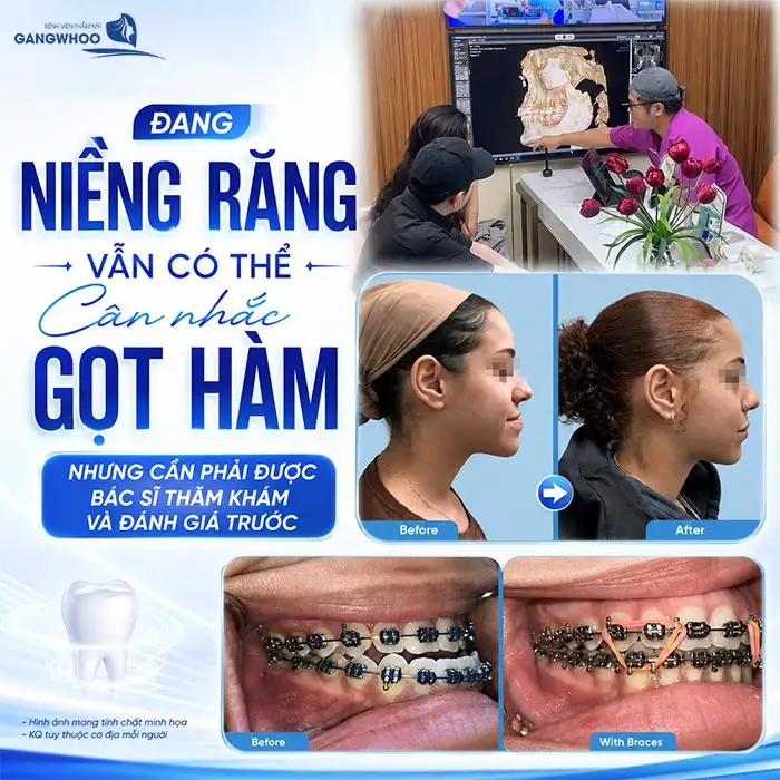 Đang Niềng Răng Có Gọt Hàm Được Không? Bác Sĩ Chia Sẻ