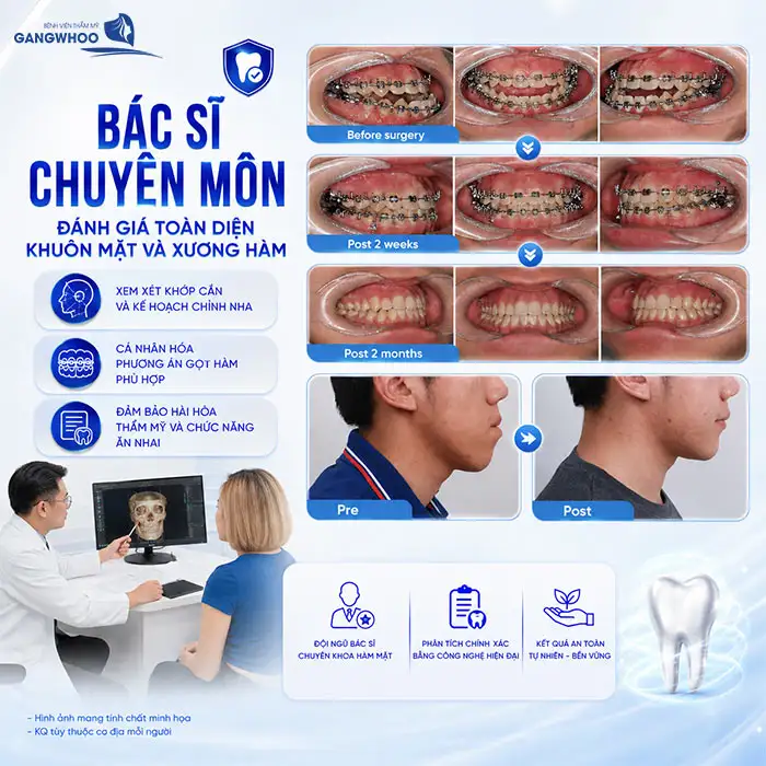 Đang Niềng Răng Có Gọt Hàm Được Không? Bác Sĩ Chia Sẻ