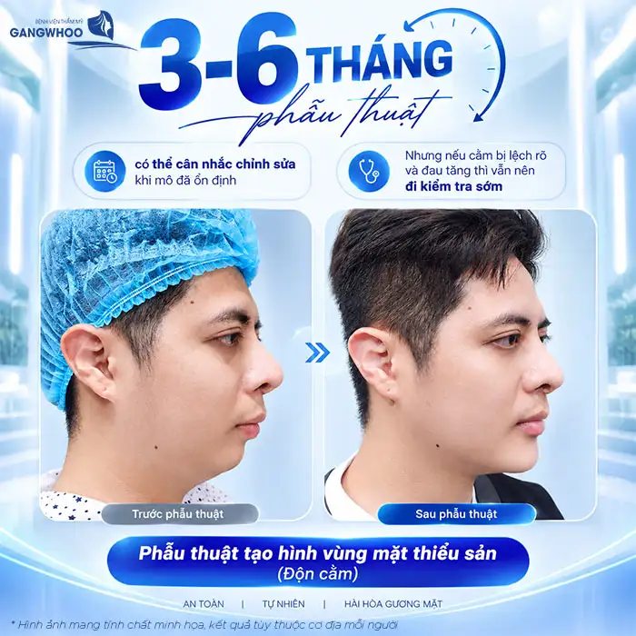 What Should I Do If My Chin Implant Is Misaligned? Dr. Phùng Mạnh Cường Explains