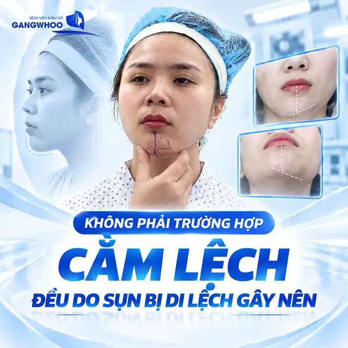 What Should I Do If My Chin Implant Is Misaligned? Dr. Phùng Mạnh Cường Explains
